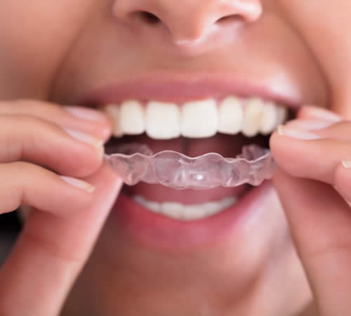 Clear Aligners technology – Invisalign